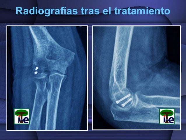 Fractura del cóndilo humeral