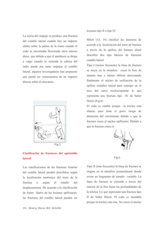 Fractura Del Condilo Humeral | PDF