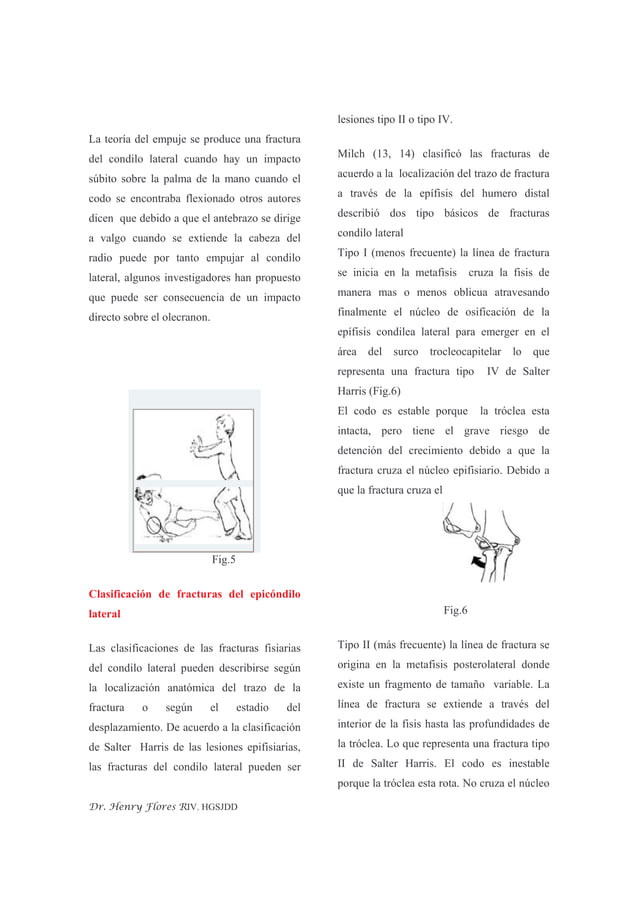 Fractura Del Condilo Humeral | PDF