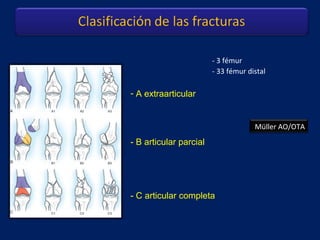 - 3 fémur
- 33 fémur distal
- C articular completa
- A extraarticular
- B articular parcial
Müller AO/OTA
 