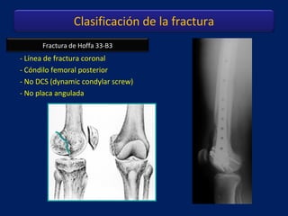 Fractura de Hoffa 33-B3
- Línea de fractura coronal
- Cóndilo femoral posterior
- No DCS (dynamic condylar screw)
- No pla...
