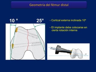 - Cortical externa inclinada 10º
- El implante debe colocarse en
cierta rotación interna
10 ° 25°
 