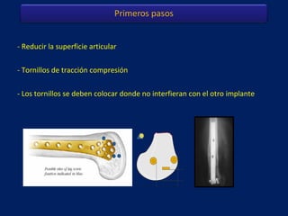 LCP - osteoporosis
 
