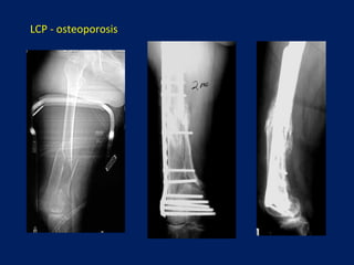 Tornillo-placa de Judet
Osteosíntesis de las fracturas distales del fémur
 