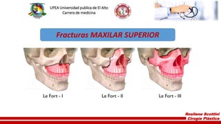 Rosilene Scottini
Cirugía Plástica
UPEA Universidad publica de El Alto
Carrera de medicina
Fracturas MAXILAR SUPERIOR
 