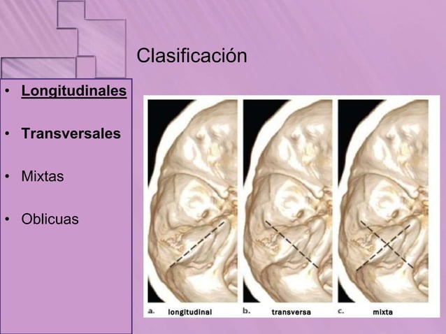 Fractura Del Pe asco Del Temporal Clase pptx fractura-del-pe-asco-del-temporal-clase-pptx