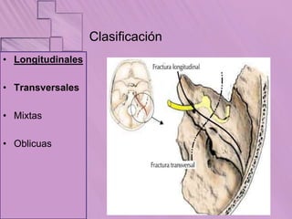 Fractura Del Pe asco Del Temporal Clase pptx fractura-del-pe-asco-del-temporal-clase-pptx