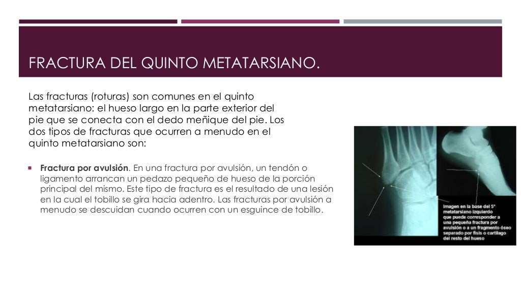 Fractura del quinto metatarsiano