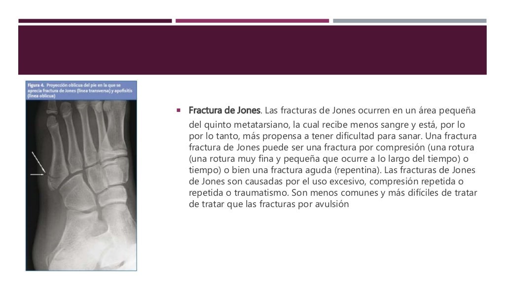 Fractura del quinto metatarsiano