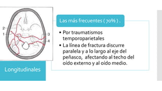 Longitudinales
• Por traumatismos
temporoparietales
• La línea de fractura discurre
paralela y a lo largo al eje del
peñasco, afectando al techo del
oído externo y al oído medio.
Las más frecuentes ( 70% ) .
 