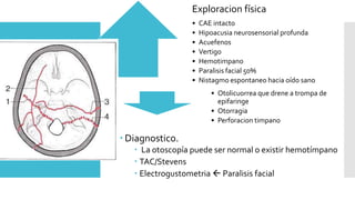  Diagnostico.
 La otoscopía puede ser normal o existir hemotímpano
 TAC/Stevens
 Electrogustometria  Paralisis facial
Exploracion física
• CAE intacto
• Hipoacusia neurosensorial profunda
• Acuefenos
• Vertigo
• Hemotimpano
• Paralisis facial 50%
• Nistagmo espontaneo hacia oído sano
• Otolicuorrea que drene a trompa de
epifaringe
• Otorragia
• Perforacion timpano
 