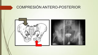 COMPRESIÓN ANTERO-POSTERIOR
 