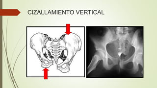 CIZALLAMIENTO VERTICAL
 