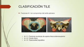 CLASIFICACIÓN TILE
 Fracturas A-1 sin compromiso del anillo pelviano
• A-1-1: Fracturas avulsivas de espina ilíaca anterossuperior
• A-1-2: Cresta ilíaca
• A-1-3: Tuberosidad isquiática
 