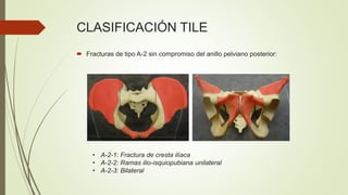 CLASIFICACIÓN TILE
 Fracturas de tipo A-2 sin compromiso del anillo pelviano posterior:
• A-2-1: Fractura de cresta ilíaca
• A-2-2: Ramas ilio-isquiopubiana unilateral
• A-2-3: Bilateral
 