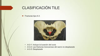 CLASIFICACIÓN TILE
 Fracturas tipo A-3:
• A-3-1: Incluye la luxación del coxis
• A-3-2: Las fracturas transversas del sacro no desplazada
• A-3-3: Desplazada
 