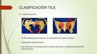 CLASIFICACIÓN TILE
• En libro abierto generadas por un mecanismo de rotación externa
• Compresión anteroposterior.
• Son fracturas con disrupción de la sínfisis del pubis e inestabilidad parcial del
anillo posterior.
 Fracturas tipo B-1:
 