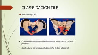 CLASIFICACIÓN TILE
• Compresión lateral o rotación interna con lesión parcial del anillo
posterior.
• Son fracturas con inestabilidad parcial o de tipo rotacional.
 Fracturas tipo B-2:
 