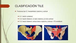 CLASIFICACIÓN TILE
 Fracturas tipo C: Inestabilidad rotatoria y vertical
 C-1: lesión unilateral
 C-2: lesión bilateral: un lado rotatoria y el otro vertical
 C-3: lesión bilateral: ambos lados rotatoria y vertical + FX acetábulo
 
