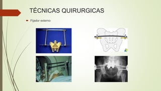 TÉCNICAS QUIRURGICAS
 Fijador externo
 