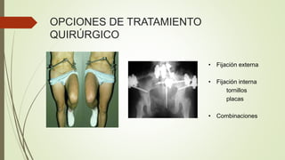 OPCIONES DE TRATAMIENTO
QUIRÚRGICO
• Fijación externa
• Fijación interna
tornillos
placas
• Combinaciones
 