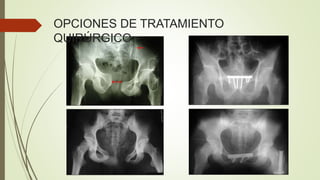 OPCIONES DE TRATAMIENTO
QUIRÚRGICO
 