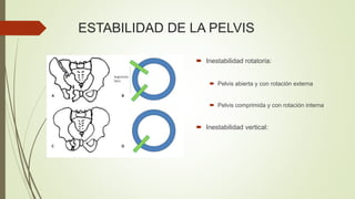 ESTABILIDAD DE LA PELVIS
 Inestabilidad rotatoria:
 Pelvis abierta y con rotación externa
 Pelvis comprimida y con rotación interna
 Inestabilidad vertical:
 