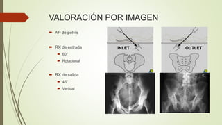 VALORACIÓN POR IMAGEN
 AP de pelvis
 RX de entrada
 60°
 Rotacional
 RX de salida
 45°
 Vertical
OUTLETINLET
 