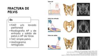 FRACTURA DE
PELVIS
• FAST y/o lavado
peritoneal
• Radiografía AP y de
entrada y salida de
pelvis ± AP de tórax
• TAC simple pelvis
• Uretrograma
retrógrado
Dx
Vista AP
Vista de entrada
Vista de salida
Grupo CTO. CTO Traumatología 3ª edición. México. 2018.
Brinker MR. Review of Orthopedic Trauma 2nd edition. Wolters Kluwers. 2013.
Russell GV. Pelvic Fractures. Medscape 2018.
Fiechtl J. Pelvic Trauma: Initial evaluation and management. Uptodate. 2019.
Burlew CC, Moore EE. Severe pelvic fracture in the adult trauma patient. Uptodate. 2019.
 