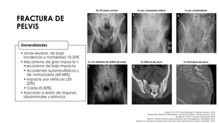 FRACTURA DE
PELVIS
Rx AP pelvis normal Fx por compresión lateral Fx por cizallamiento
Fx con diástasis de sínfisis de pubis Fx oblicua de sacro Fx transversa de sacro
• Leves-severas, de baja
incidencia y mortalidad 10-20%
• Mecanismo de gran impacto >
mecanismo de bajo impacto
• Accidentes automovilísticos y
de motocicleta (43-58%)
• Impacto por vehículo (20-
22%)
• Caída (5-30%)
• Asociado a lesión de órganos
abdominales y pélvicos
Generalidades
Grupo CTO. CTO Traumatología 3ª edición. México. 2018.
Brinker MR. Review of Orthopedic Trauma 2nd edition. Wolters Kluwers. 2013.
Russell GV. Pelvic Fractures. Medscape 2018.
Fiechtl J. Pelvic Trauma: Initial evaluation and management. Uptodate. 2019.
Burlew CC, Moore EE. Severe pelvic fracture in the adult trauma patient. Uptodate. 2019.
 