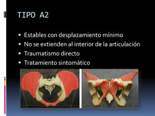TIPO A2
 Estables con desplazamiento mínimo
 No se extienden al interior de la articulación

 Traumatismo directo
 Tratamiento sintomático

 