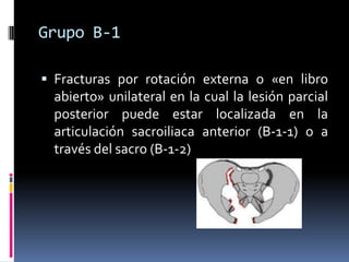 Grupo B-1
 Fracturas por rotación externa o «en libro

abierto» unilateral en la cual la lesión parcial
posterior puede estar localizada en la
articulación sacroiliaca anterior (B-1-1) o a
través del sacro (B-1-2)

 