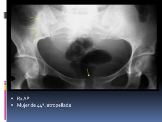  Rx AP
 Mujer de 44ª. atropellada

 