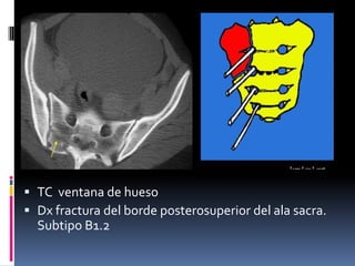  TC ventana de hueso
 Dx fractura del borde posterosuperior del ala sacra.
Subtipo B1.2

 