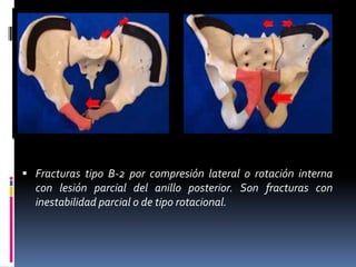  Fracturas tipo B-2 por compresión lateral o rotación interna

con lesión parcial del anillo posterior. Son fracturas con
inestabilidad parcial o de tipo rotacional.

 