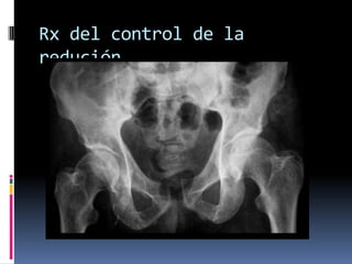 Rx del control de la
redución

 