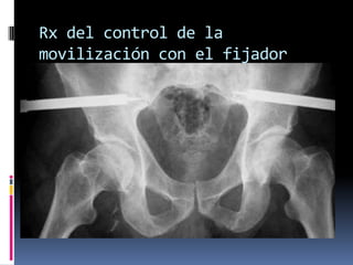 Rx del control de la
movilización con el fijador
externo

 