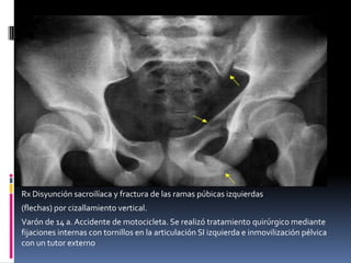Rx Disyunción sacroilíaca y fractura de las ramas púbicas izquierdas
(flechas) por cizallamiento vertical.
Varón de 14 a. Accidente de motocicleta. Se realizó tratamiento quirúrgico mediante
fijaciones internas con tornillos en la articulación SI izquierda e inmovilización pélvica
con un tutor externo

 