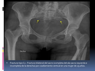 

Fractura tipo C2 : Fractura bilateral del sacro (completa del ala sacra izquierda e
incompleta de la derecha) por cizallamiento vertical en una mujer de 29 años.

 