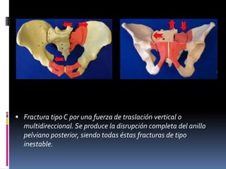  Fractura tipo C por una fuerza de traslación vertical o

multidireccional. Se produce la disrupción completa del anillo
pelviano posterior, siendo todas éstas fracturas de tipo
inestable.

 