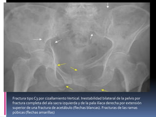 Fractura tipo C3 por cizallamiento Vertical. Inestabilidad bilateral de la pelvis por
fractura completa del ala sacra izquierda y de la pala ilíaca derecha por extensión
superior de una fractura de acetábulo (flechas blancas). Fracturas de las ramas
púbicas (flechas amarillas)

 