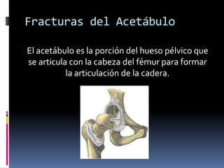 Fracturas del Acetábulo
El acetábulo es la porción del hueso pélvico que
se articula con la cabeza del fémur para formar
la articulación de la cadera.

 