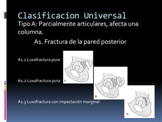 Clasificacion Universal
Tipo A: Parcialmente articulares, afecta una
columna.
A1. Fractura de la pared posterior
A1.1 Luxofractura pura

A1.2 Luxofractura pura

A1.3 Luxofractura con impactación marginal

 