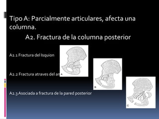 Tipo A: Parcialmente articulares, afecta una
columna.
A2. Fractura de la columna posterior
A2.1 Fractura del Isquion

A2.2 Fractura atraves del anillo obturador

A2.3 Asociada a fractura de la pared posterior

 