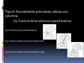 Tipo A: Parcialmente articulares, afecta una
columna.
A3. Fractura de la columna o pared anterior
A3.1 Fractura de la pared anterior

A3.2 Fractura de la columna anterior alta

A3.3 Fractura de la columna anterior baja

 