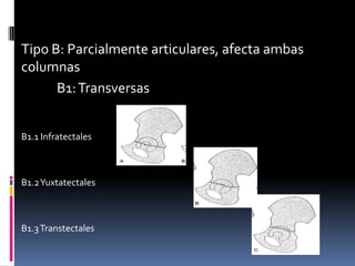 Tipo B: Parcialmente articulares, afecta ambas
columnas
B1: Transversas
B1.1 Infratectales

B1.2 Yuxtatectales

B1.3 Transtectales

 