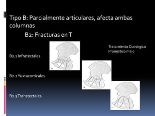 Tipo B: Parcialmente articulares, afecta ambas
columnas
B2: Fracturas en T
Tratamiento Quirúrgico
Pronostico malo

B2.1 Infratectales

B2.2 Yuxtacorticales

B2.3 Transtectales

 