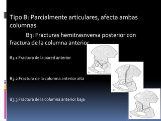 Tipo B: Parcialmente articulares, afecta ambas
columnas
B3: Fracturas hemitrasnversa posterior con
fractura de la columna anterior
B3.1 Fractura de la pared anterior

B3.2 Fractura de la columna anterior alta

B3.3 Fractura de la columna anterior baja

 