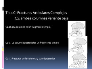 Tipo C: Fracturas Articulares Complejas
C2: ambas columnas variante baja
C2.1Cada columna es un fragmento simple,

C2-2. La columna posteriores un fragmento simple

C2-3. Fracturas de la columna y pared posterior

 