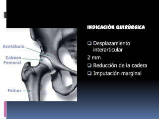 Indicación quirúrgica
 Desplazamiento

interarticular
2 mm
 Reducción de la cadera
 Imputación marginal

 